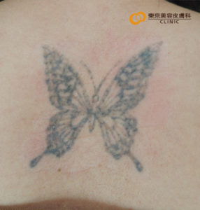 蝶のタトゥー除去