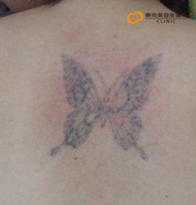 蝶のタトゥー除去